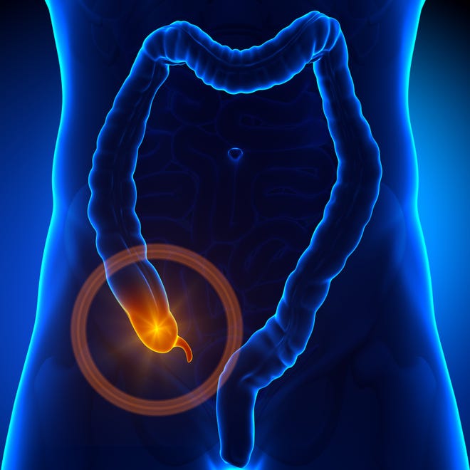 Cancer of the appendix is a very rare condition.